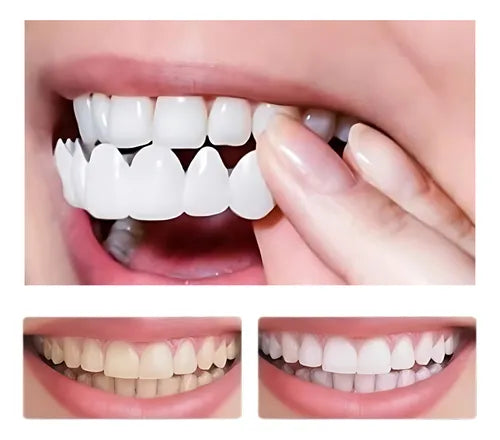 CARILLAS DENTALES